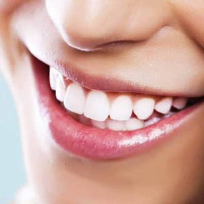 Teeth Whitening Treatment (1 Session)